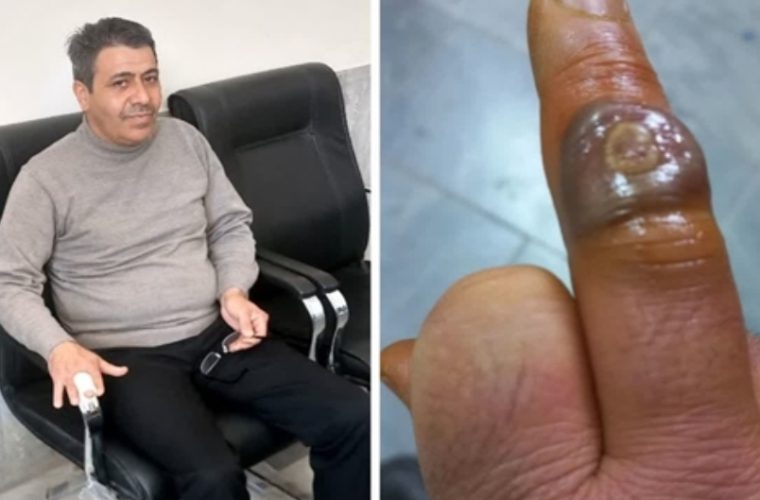 مصدومیت کارشناس شبکه دامپزشکی شهرستان خوانسار از ناحیه دست